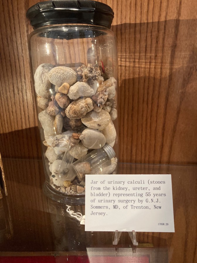 Jar filled with kidney stones.